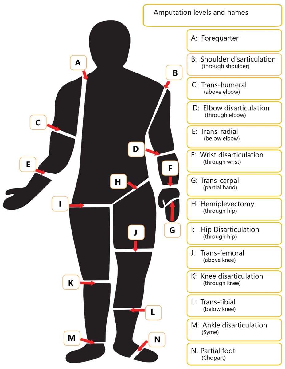 Amputation levels names amputees qld